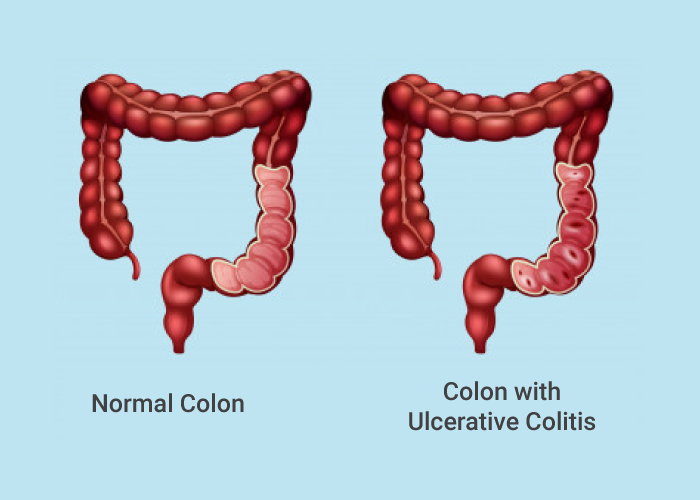 4 Best Ways to Manage Ulcerative Colitis Pain