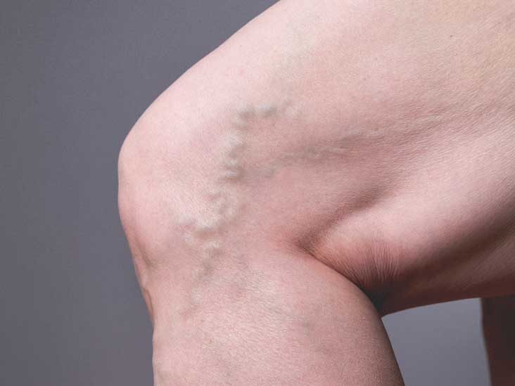 7 Things That Increase the Risk for Blood Clots and Deep Vein Thrombosis 7 Things That Increase the Risk for Blood Clots and Deep Vein Thrombosis