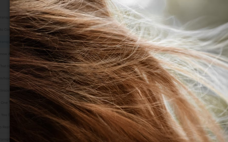 How to Choose a Hair Transplant Clinic