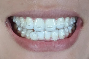 9 Things No One Tells You About Invisalign, But You’ll Wish You Knew Sooner